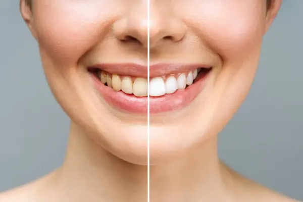 brentwood-dental-BeforeAfter